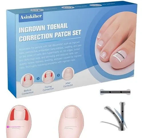 Titanium Ingrown Toenail Tools Clip C…